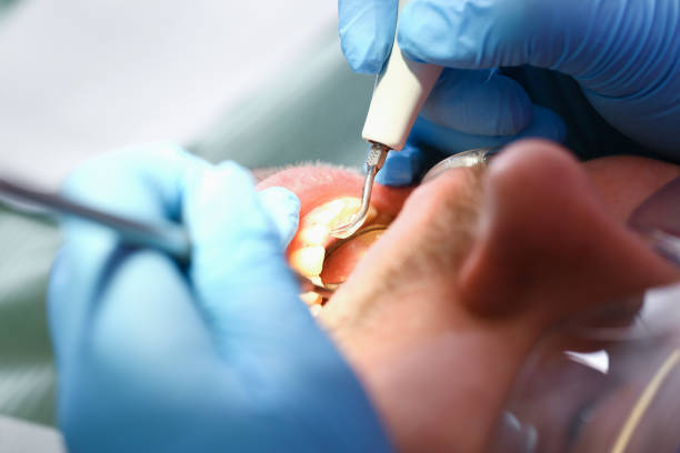 Best Broken or Chipped Tooth Repair in Hobart, WA