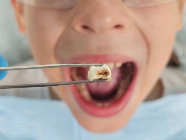 Best Emergency Wisdom Tooth Extraction in Hobart, WA
